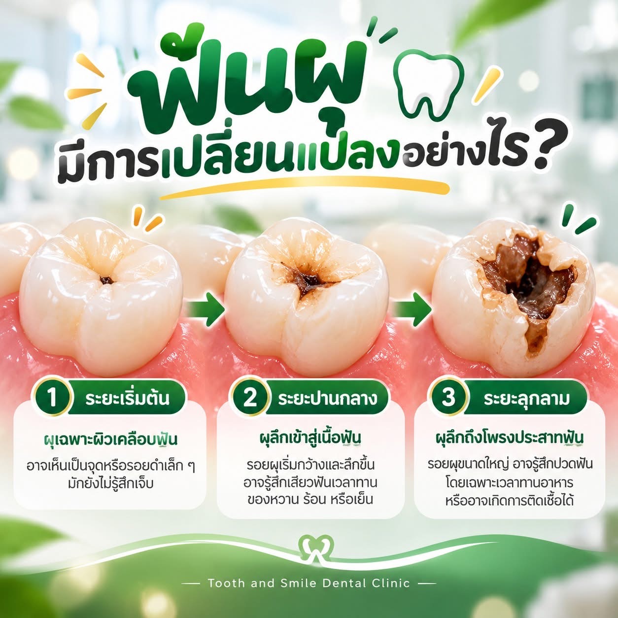 สื่อความรู้เรื่องการเปลี่ยนแปลงของฟันผุ