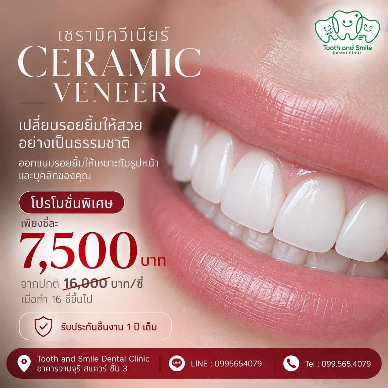 เซรามิกวีเนียร์ 7,500 บาทต่อซี่ เมื่อทำ 16 ซี่ขึ้นไป